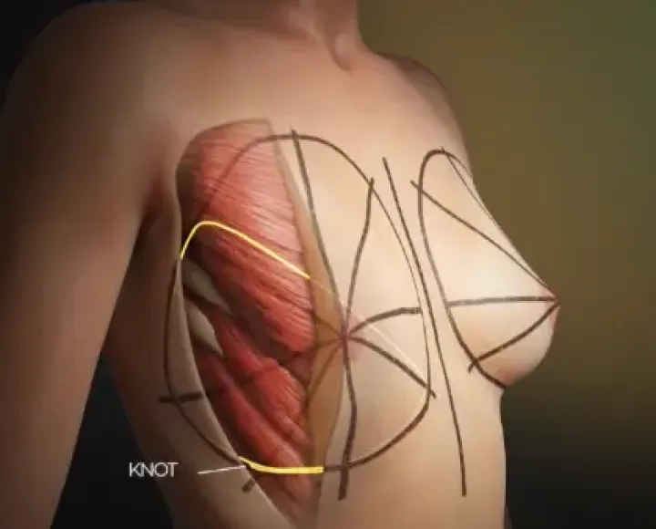 Medical 3D animation