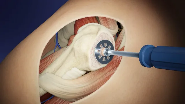 13 3D video films — Orthopedic surgery