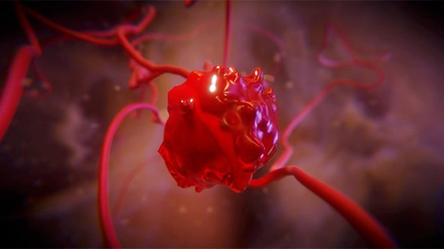 3D animated film — CHU de Lille