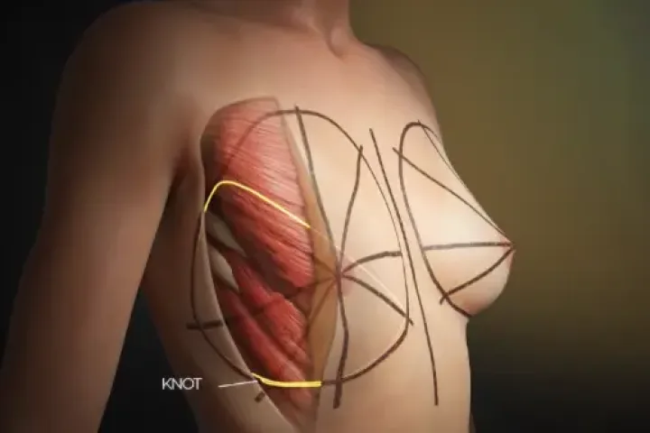 Medical 3D animation