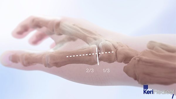 KeriMedical — trapeziometacarpal implant